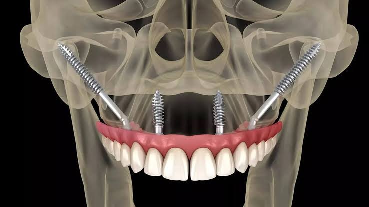 Zigomatik İmplant Nedir? Kimlere Uygulanabilir? 7 Önemli Bilgi